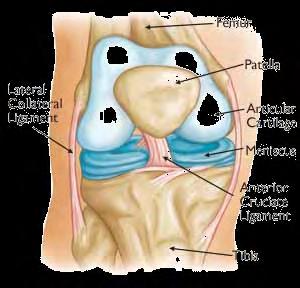 41 ΚΕΦΑΛΑΙΟ 4 ΟΛΙΚΗ ΑΡΘΡΟΠΛΑΣΤΙΚΗ ΓΟΝΑΤΟΣ Λέγοντας ολική αρθροπλαστική γόνατος (Total Knee Arthroplasty - ΤΚΑ) εννοούμε τη χειρουργική επέμβαση η οποία συνίσταται στην αντικατάσταση των αρθρικών