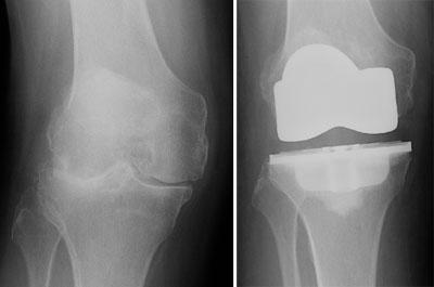 46 Εικόνα 4. Σχηματική και ακτινολογική απεικόνιση της αντικατάστασης της φθαρμένης άρθρωσης Επιπλοκές ολικής αρθροπλαστικής γόνατος Σοβαρές επιπλοκές σπάνια εμφανίζονται.