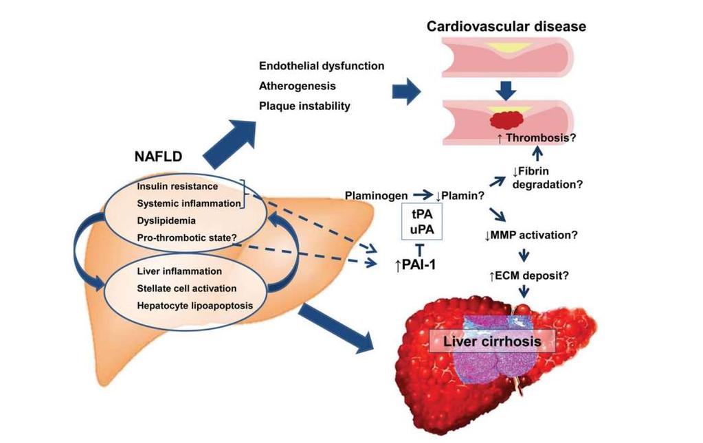 NAFLD and