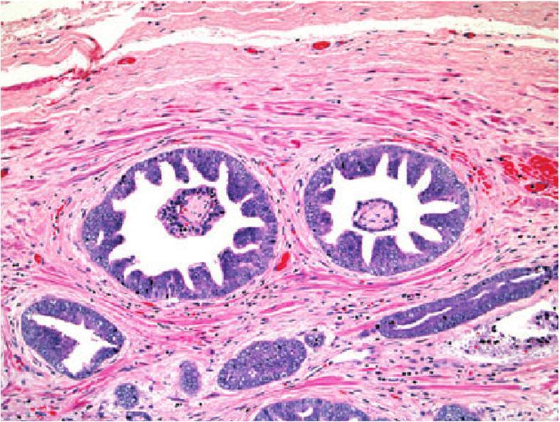 Αδενοκαρκίνωμα ομοιάζον με PIN (PIN-like [ductal] adenocarcinoma) Σε κάποια περιστατικά παρατηρούνται υψηλά κυλινδρικά κύτταρα, όπως και στο αδενοκαρκίνωμα των πόρων Αδενοκαρκίνωμα των
