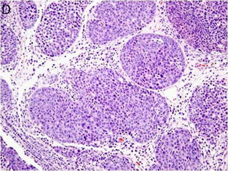 Νευροενδοκρινές καρκίνωμα από μεγάλα κύτταρα (Large-cell neuroendocrine carcinoma)