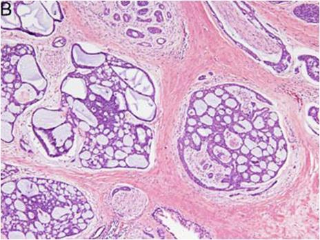 Διαυγοκυτταρικό καρκίνωμα (Clear cell carcinoma)