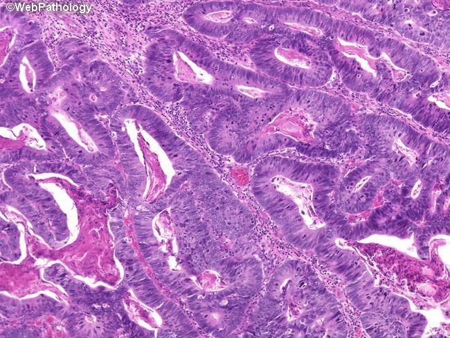 Adenocarcinoma, NOS (enteric, mucinous, mixed) 0,5-2% των όγκων της ουροδόχου CDX2+,