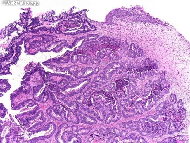 Urachal carcinoma (adenocarcinoma) Προέλευση από υπολλείμματα ουραχού με εντερική μεταπλασία Εντόπιση στο θόλο ή το πρόσθιο τοίχωμα Επίκεντρο όγκου