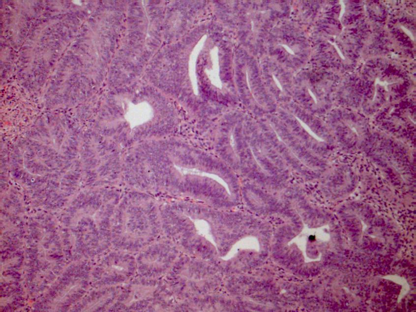 Tumours of Mullerian type Clear cell carcinoma(mesonephric)