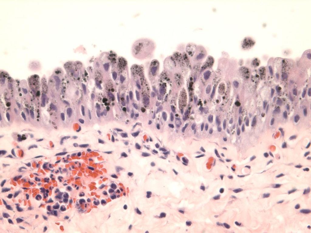 Melanocytic tumours