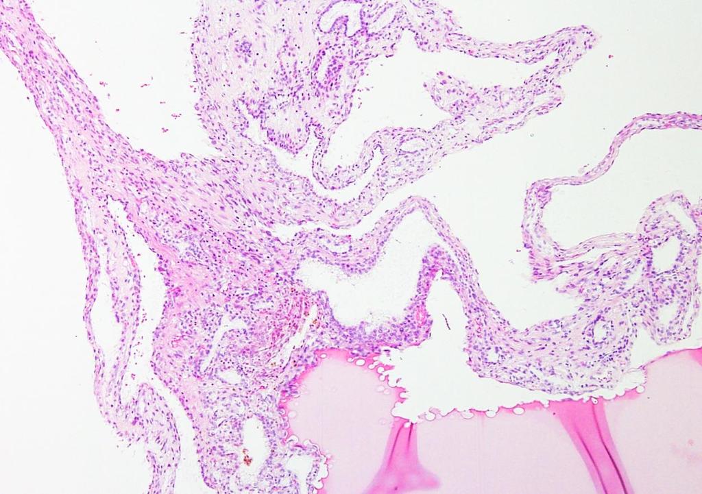 Multilocular cystic renal cell neoplasm of low malignant potential <1% των