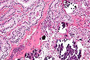 MiT family translocation renal cell carcinoma Γονιδιακές συντήξεις στα TFE3 και