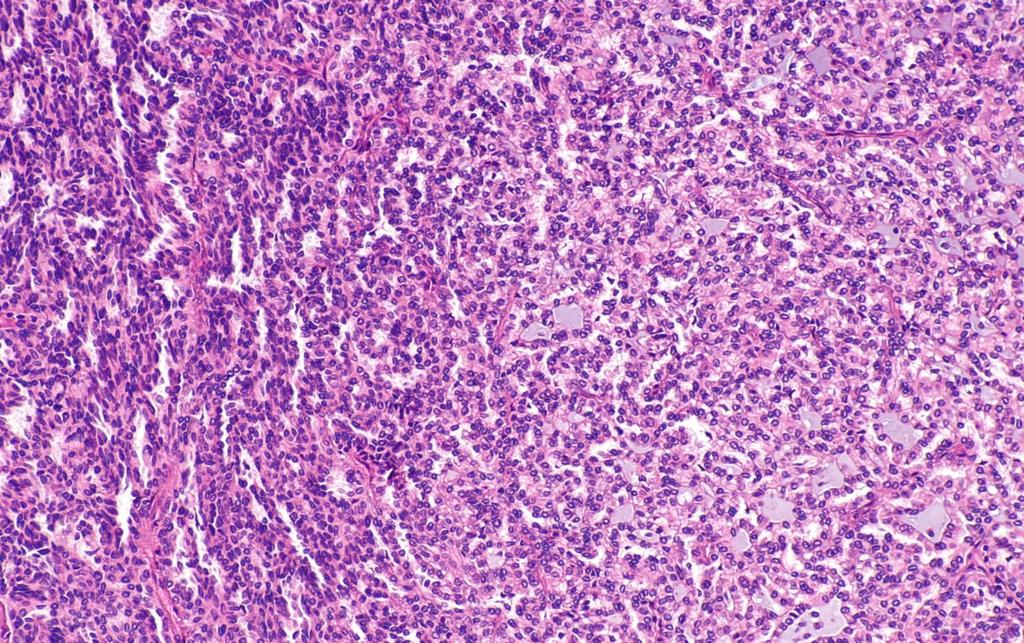 Mucinous tubular and spindle cell carcinoma <1% των