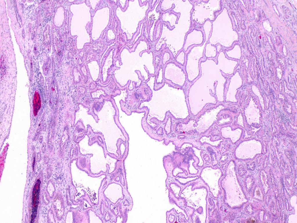 Tubulocystic renal cell carcinoma <1% των καρκινωμάτων του νεφρού