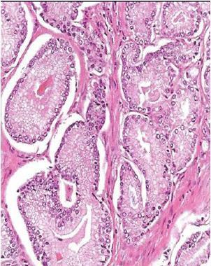 Ψευδοϋπερπλαστικό αδενοκαρκίνωμα (Pseudohyperplastic adenocarcinoma) Δεν υπάρχουν γνωστά κλινικά, ακτινολογικά ή μακροσκοπικά χαρακτηριστικά ειδικά για αυτό το