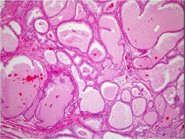 Μικροκυστικό αδενοκαρκίνωμα (Microcystic adenocarcinoma) Είναι μία μορφή ατροφικής και/ή ψευδοϋπερπλαστικής