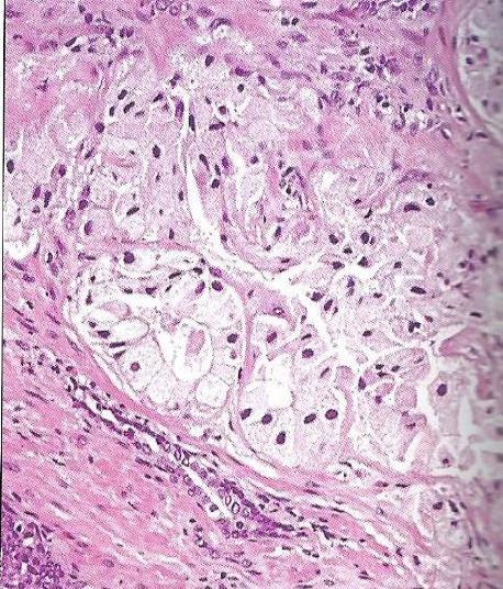 Αδενοκαρκίνωμα με μικροκενοτοπιώδες κυτταρόπλασμα (Adenocarcinoma with microvacuolated cytoplasm: foamy gland carcinoma xanthomatoid carcinoma) Μέσος όρος ηλικίας 65 έτη (50-78) PSA ορού Σε ριζική