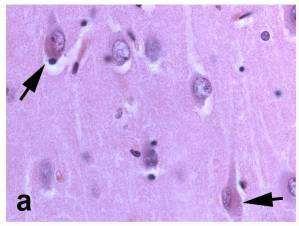 Νευροϊνιδιακές αλλοιώσεις Χρώση αιματοξυλίνη/εωσίνη Νευροϊνιδιακοί κόμβοι ή δεμάτια, ή πλέγματα νευροϊνιδίων: μικροσκοπικές κακώσεις