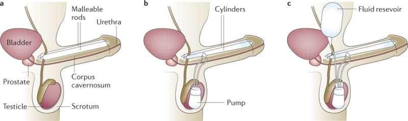 Types of penile prostheses Yafi FA, et