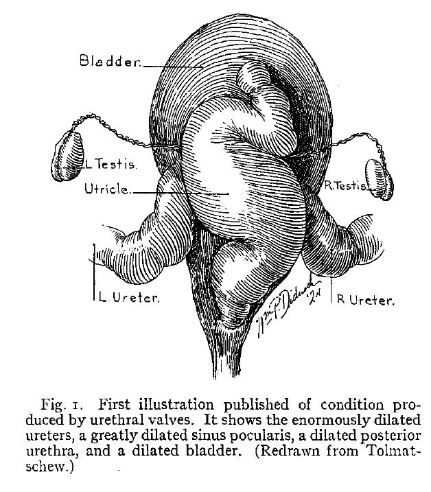 Διαπίστωση υμενώδους απόφραξης οπίσθιας ουρήθρας και δευτεροπαθείς αλλοιώσεις ουροδόχου και ανωτέρου ουροποιητικού Ιστορία 1870: ο Tolmatschew δημοσιεύει τα νεκροτομικά