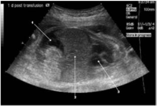 Parvo B19 και εγκυμοσύνη Πιθανή προσβολή ή έκθεση μητέρας Η διάγνωση απαιτεί ανίχνευση των ειδικών IgG και IgM αντισωμάτων (τα IgM παραμένουν θετικά για 3 μήνες περίπου και τα IgG δια βίου).