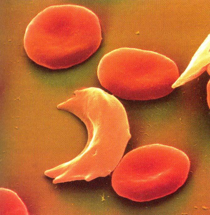 Srpasta anemija primjer za pogrešnu (missense) mutaciju Adultni hemoglobin tetramerni protein, α 2 β 2 Srpasta anemija nastaje zbog mutacije u genu za sintezu β-lanca hemoglobina Alel za zdravi