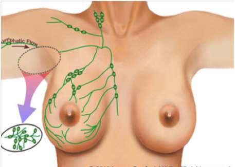 Δευτεροπαθές λεμφοίδημα μετά μαστεκτομή Λεμφαδενικός καθαρισμός Ακτινοθεραπεία Ασθενείς με Ca μαστού θα εμφανίσουν λεμφοίδημα 20-30% μετά αφαίρεση λεμφαδένων μασχάλης 40-50% εφόσον