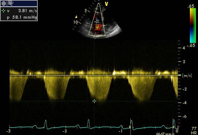 Echocardiography LV : EF 65 % RV: