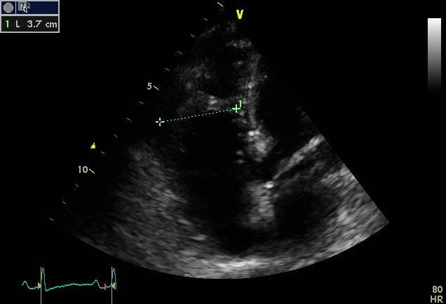 Echocardiography LV : EF 65 % RV: