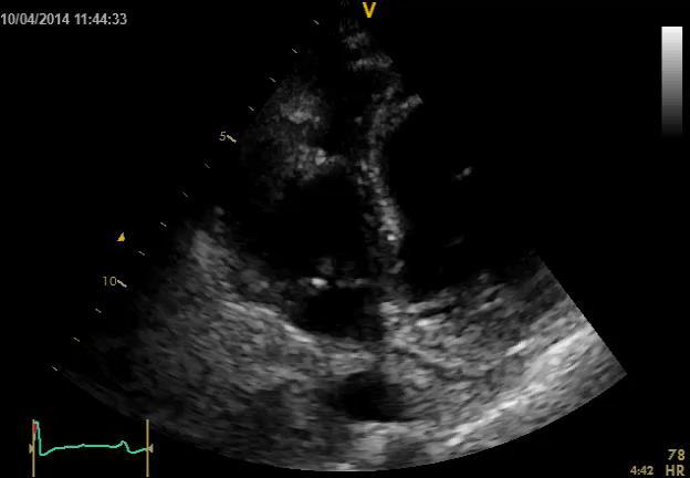 Echocardiography LV : EF 65 % RV: