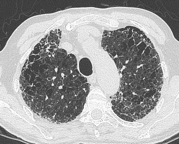 PH in combined pulmonary fibrosis and emphysema Sex, male - female 38-2 Mean age, years 68.