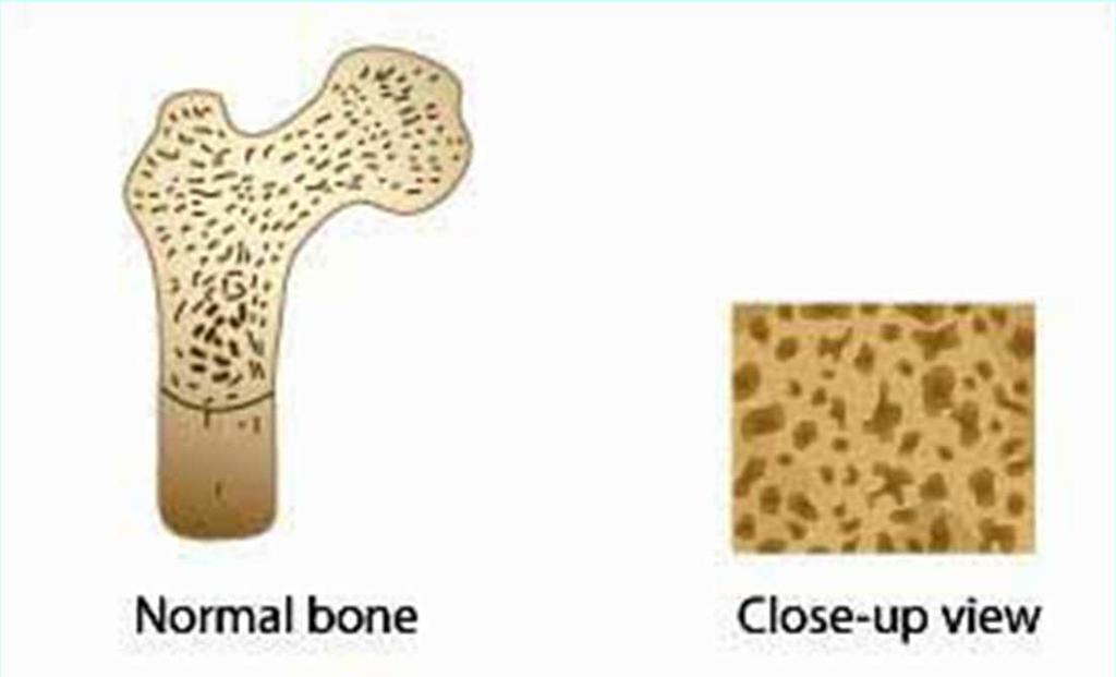 ΔΙΑΤΡΟΦΗ ΚΑΙ ΟΣΤΕΟΠΟΡΩΣΗ Ηαπώλεια της οστικής πυκνότητας έχει σαν συνέπεια την απώλεια της ικανότητας του οστού να επιτελεί το καθήκον του, δηλαδή