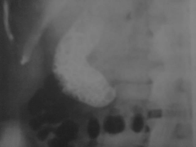 Εικόνα 4. Χολοκυστογραφία per os που δείχνει πολλαπλούς χολόλιθους μέσα στη χοληδόχο κύστη.