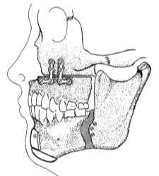 [uvula-palato-pharyngoplastry,uppp] /γλωσσεκτομή) 2.