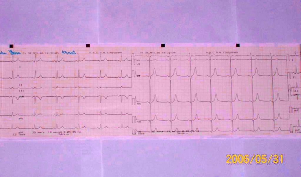 TRASEU ECG