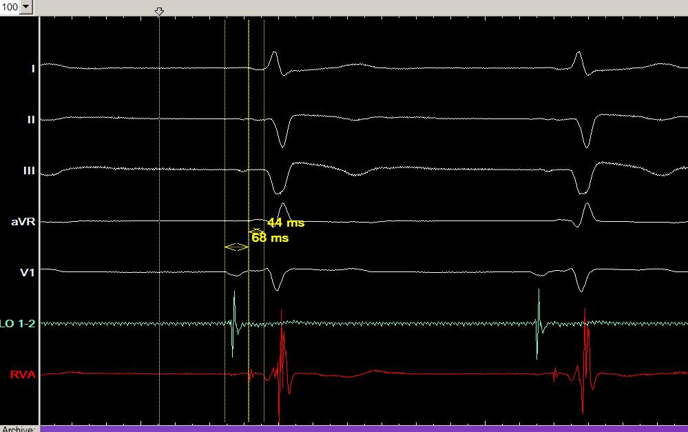 AH = 68msec