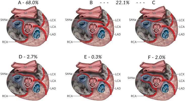 (2016) Anatomical Variations in the Sinoatrial Nodal Artery: A Meta-Analysis and