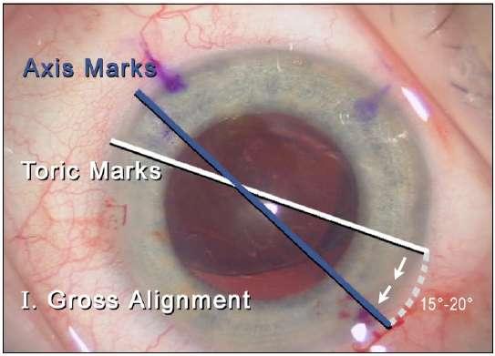 AcrySof IQ Toric IOL 3 βήμαηα για ηην εςθςγπάμμιζη