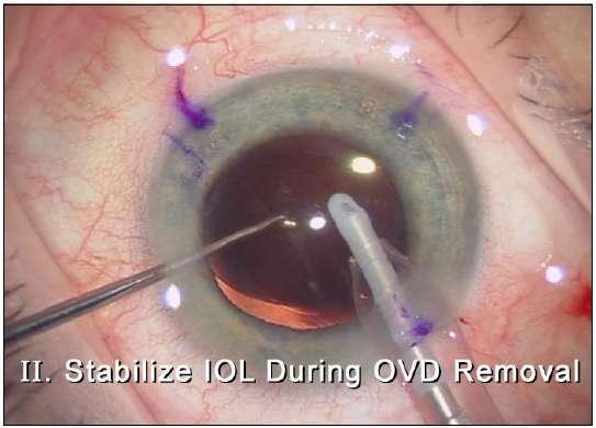 AcrySof IQ Toric IOL 3 βήμαηα για ηην εςθςγπάμμιζη ηος IOL: 2.