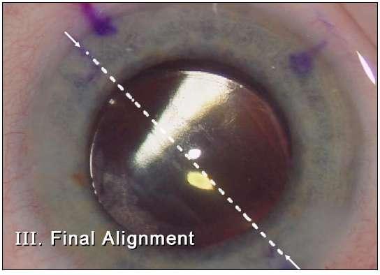 AcrySof IQ Toric IOL 3 βήμαηα για ηην εςθςγπάμμιζη ηος IOL: 3.