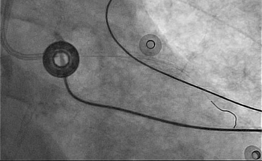 και δεξιά Stent thrombosis Mortality: