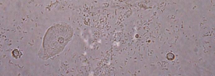 Slika 9. Uroepitelna celica v sedimentu urina IV (40x povečava) Pustimo, da urin odteče.