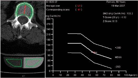 Kvantitatīvās datortomogrāfijas izmantošana OP diagnostikā Kvantitatīvā datortomogrāfija (QCT) ir atzīta metode KMB no teikšanai aksiālajā (Th 12 -L 3 skriemeļi) un