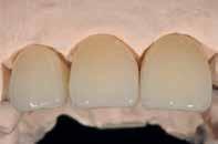 Ωστόσο, η μορφολογία των προσωρινών αποκαταστάσεων δε σχεδιάστηκε για να προσομοιάζει τα φυσικά δόντια, αλλά για το αυχενικό τμήμα των αποκαταστάσεων για να καλύπτει τα παρειακά ούλα.