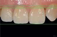 Κατά την τελική δοκιμή εξετάστηκαν προσεκτικά η εφαρμογή στα όρια, η μορφολογία και τα σημεία επαφής, η αντιστοιχία των ορίων των αποκαταστάσεων και των ουλικών κολάρων γύρω από τα δόντια στηρίγματα.