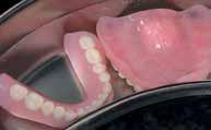 Ο ασθενής είχε ήδη χάσει αρκετά από τα δόντια του και τα εναπομείναντα δόντια ήταν αμφίβολα λόγω περιοδοντικής κατάστασης(εικ. 2).