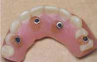 6 Οι κλασικές οδοντοστοιχίες κατασκευάστηκαν πριν από τη χειρουργική επέμβαση έτσι ώστε να τροποποιηθούν άμεσα και να λειτουργήσουν ως προσωρινές αποκαταστάσεις κατά τη φάση επούλωσης. Εικ. 7α Εικ.
