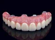 Τα μικρά κενά γύρω από τους συνδέσμους της οδοντοστοιχίας γεμίστηκαν με φωτοπολυμεριζόμενη ρητίνη σε ροζ απόχρωση(εικ. 24).
