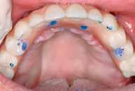 24 Χρησιμοποιήθηκε αυτοπολυμεριζόμενο ακρυλικό για τη σύλληψη των μεταλλικών υποδοχών στην επένθετη οδοντοστοιχία και την έμφραξη των