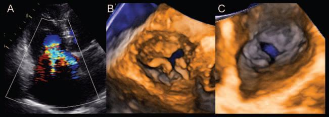 The tricuspid valve complex is analogous to the mitral valve, coordination of annular, leaflet, chordal, papillary muscle, and RV