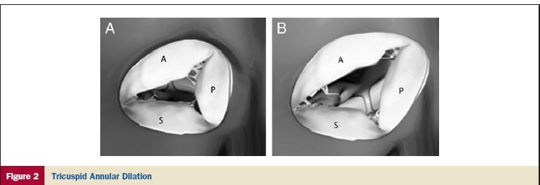 The average tricuspid annular diameter in normal individuals is 21 ± 2 mm/m2 body surface area (BSA) and the average tricuspid annular circumference is 78 ± 7 mm/m2 BSA.