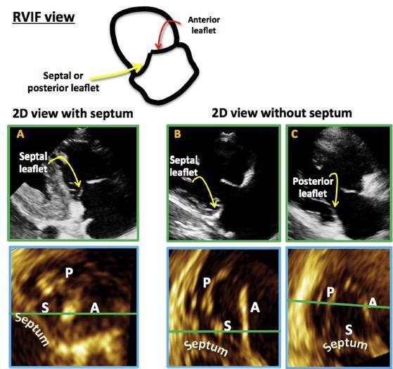 Comprehensive Two-Dimensional Interrogation of the Tricuspid Valve Using Knowledge Derived from Three-Dimensional Echocardiography Karima Addetia, MD, Megan Yamat, RDCS,