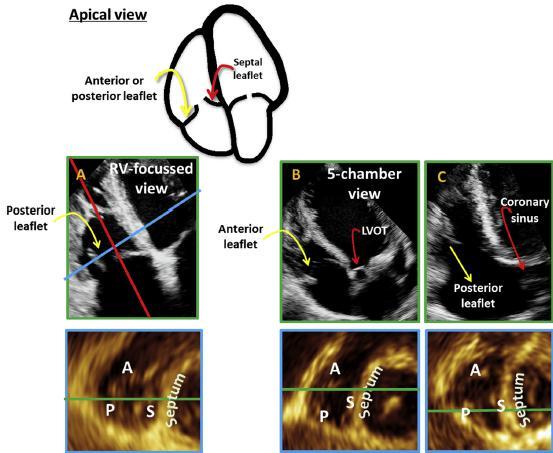 Comprehensive Two-Dimensional Interrogation of the Tricuspid Valve Using Knowledge Derived from Three-Dimensional Echocardiography Karima Addetia, MD, Megan Yamat, RDCS,