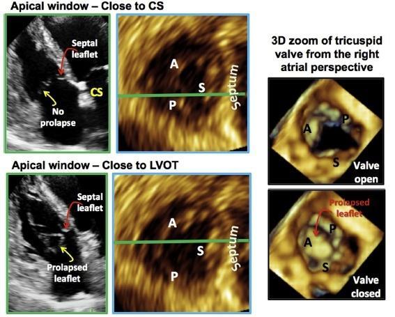 Comprehensive Two-Dimensional Interrogation of the Tricuspid Valve Using Knowledge Derived from Three-Dimensional Echocardiography Karima Addetia, MD, Megan Yamat, RDCS,